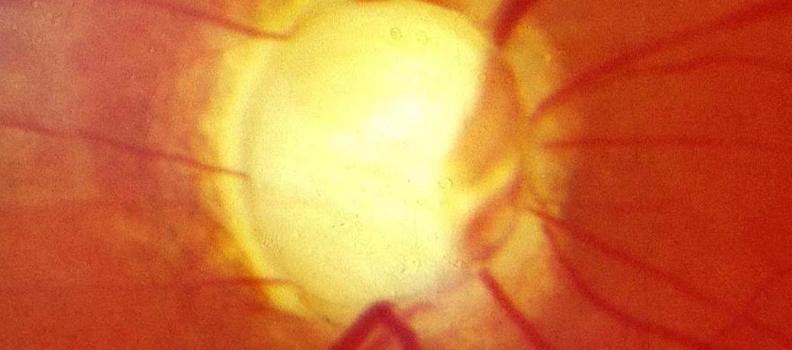 O que é o Glaucoma ?