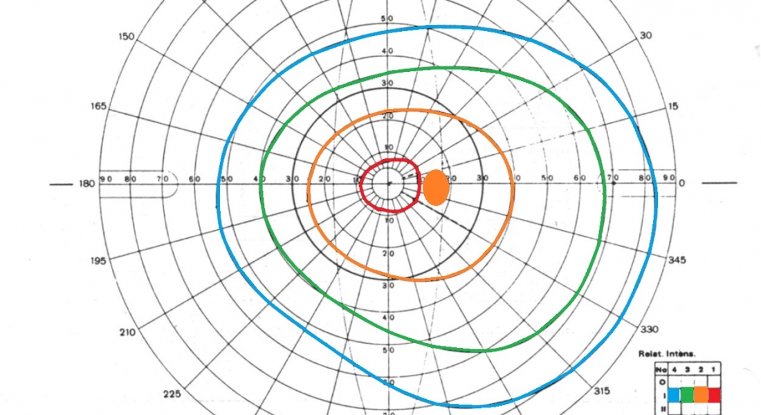 É possível recuperar a visão / campo visual perdido com o Glaucoma ?